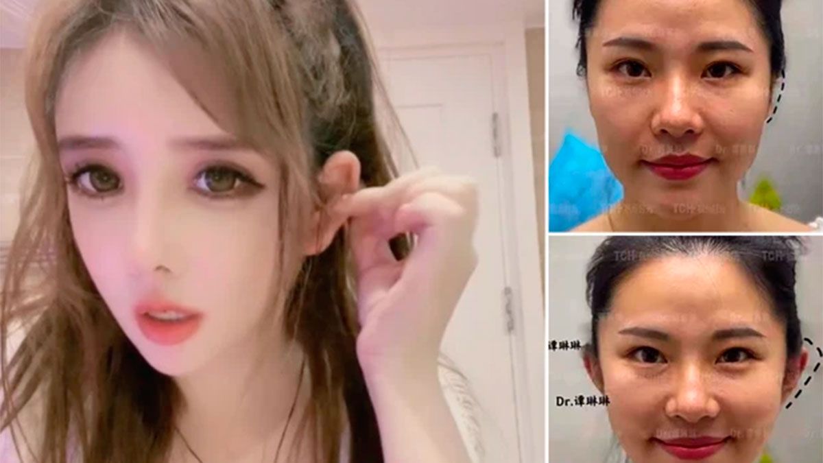 Una joven se someterse a tres operaciones de cirugía estética para tener  orejas de elfo