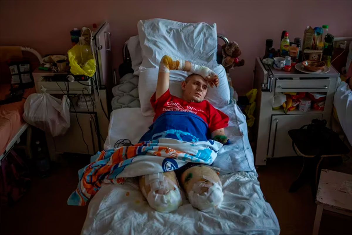 Anton Gladun, de 22 años, yace en su cama del Hospital Tercera Ciudad de Cherkasy, Ucrania. El médico militar perdió ambas piernas por al explosión de una mina. 