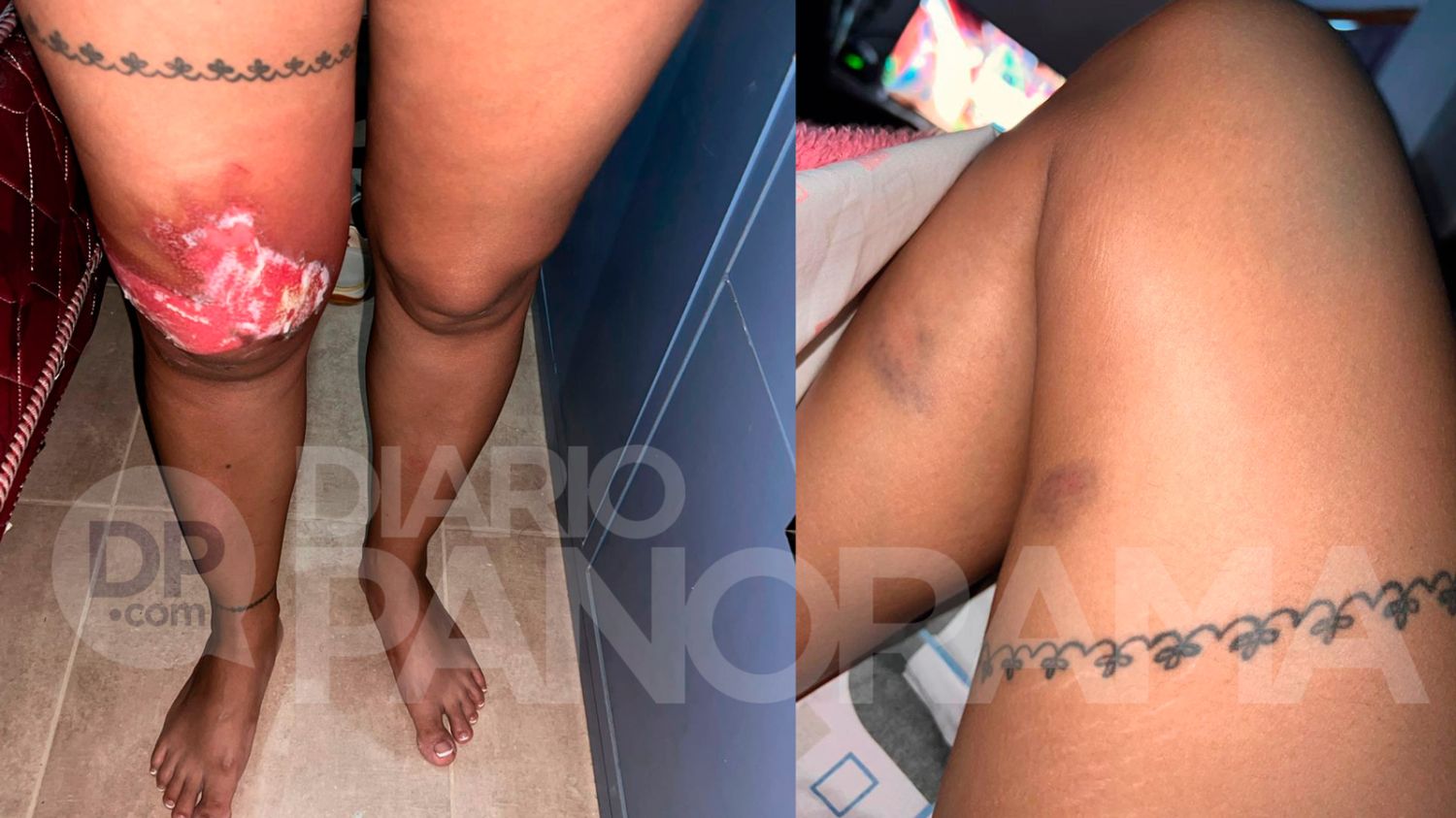 La quemadura y hematomas 