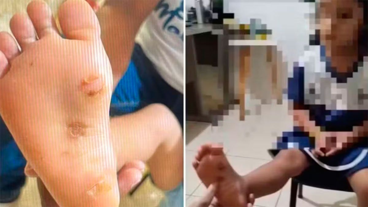  La nena tenía quemaduras en los pies 