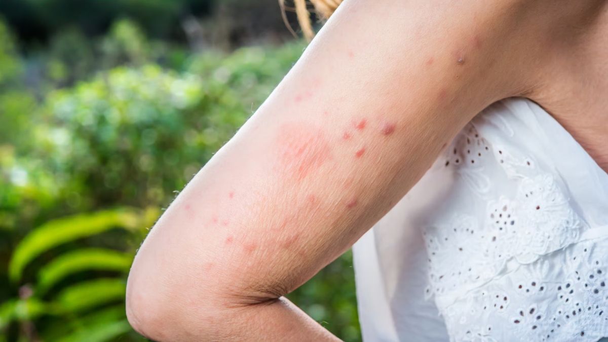 La herida del barigüí puede infectarse si la persona se rasca, lo que facilita la entrada de bacterias y complicando la recuperación 