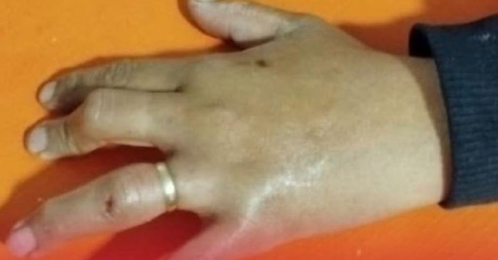 Bomberos logran salvar dedo de mujer tras accidente en Orán
