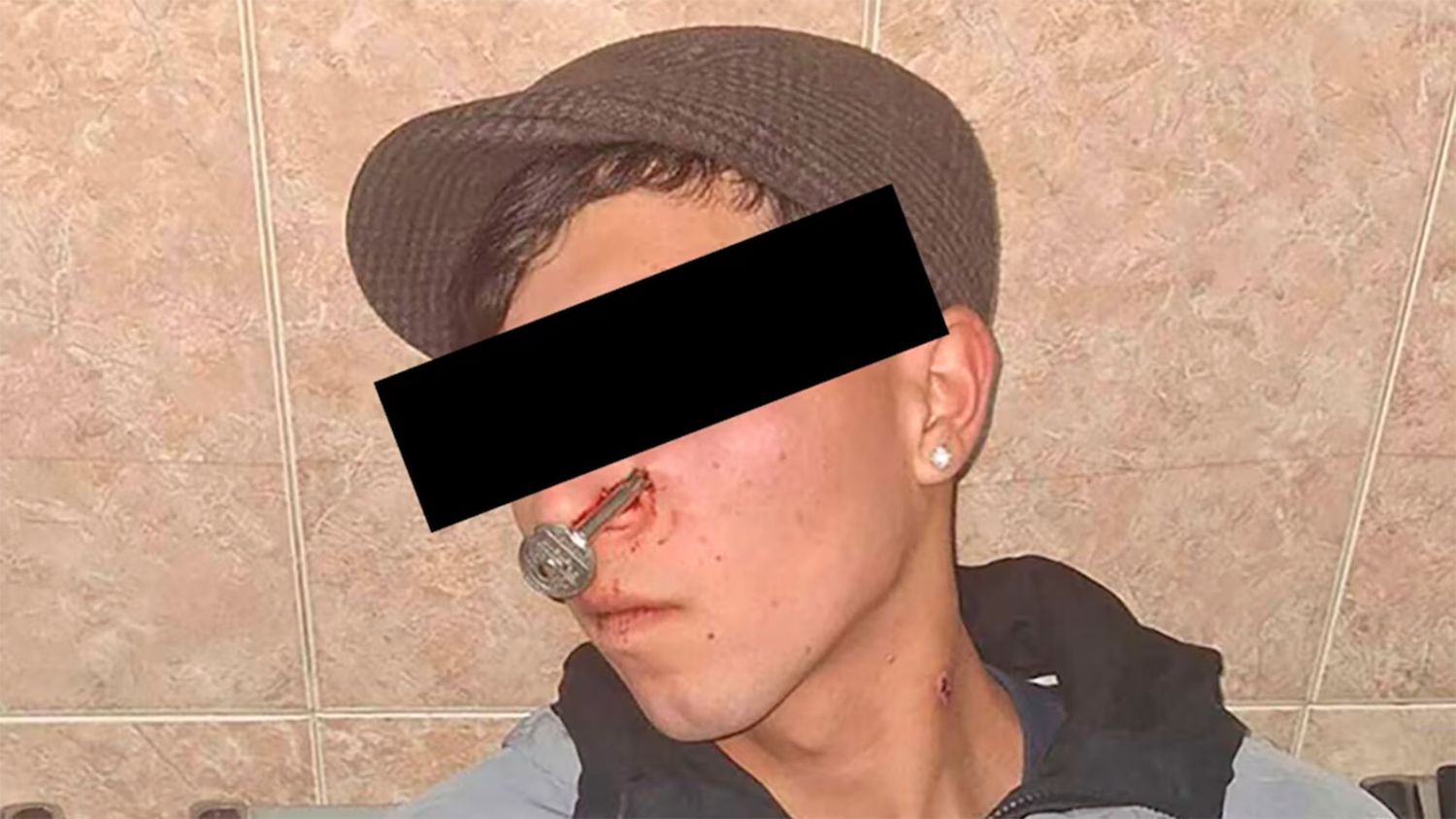 El herido con la llave en el rostro 